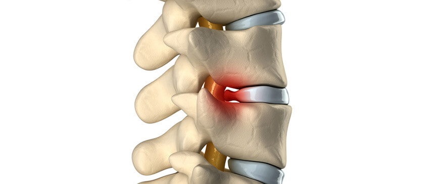 Herniated Disc Relief: FAQs