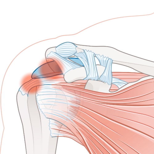 physical-therapy-clinic-tendonitis-marketplace-pt-chino-ca